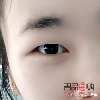 腫眼泡應(yīng)該怎么改善(腫眼泡怎么改善啊)