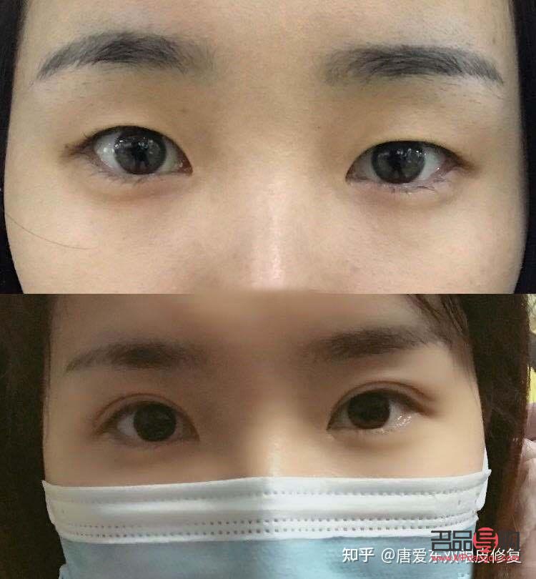 腫眼泡應(yīng)該怎么改善(腫眼泡怎么改善啊)