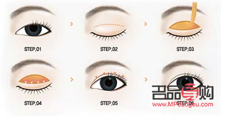 <h3>雙眼皮大小眼問(wèn)題能否恢復(fù)探討</h3>