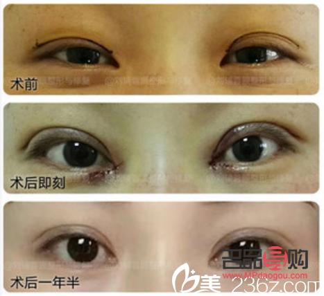 雙眼皮美容價(jià)格(雙眼皮美容價(jià)格表圖片)