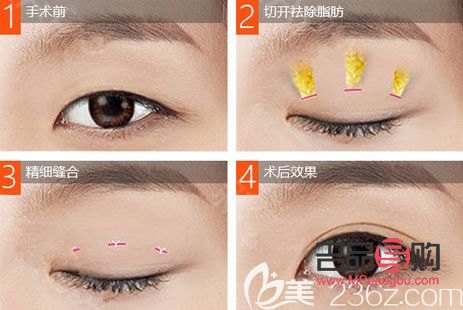 雙眼皮美容價(jià)格(雙眼皮美容價(jià)格表圖片)