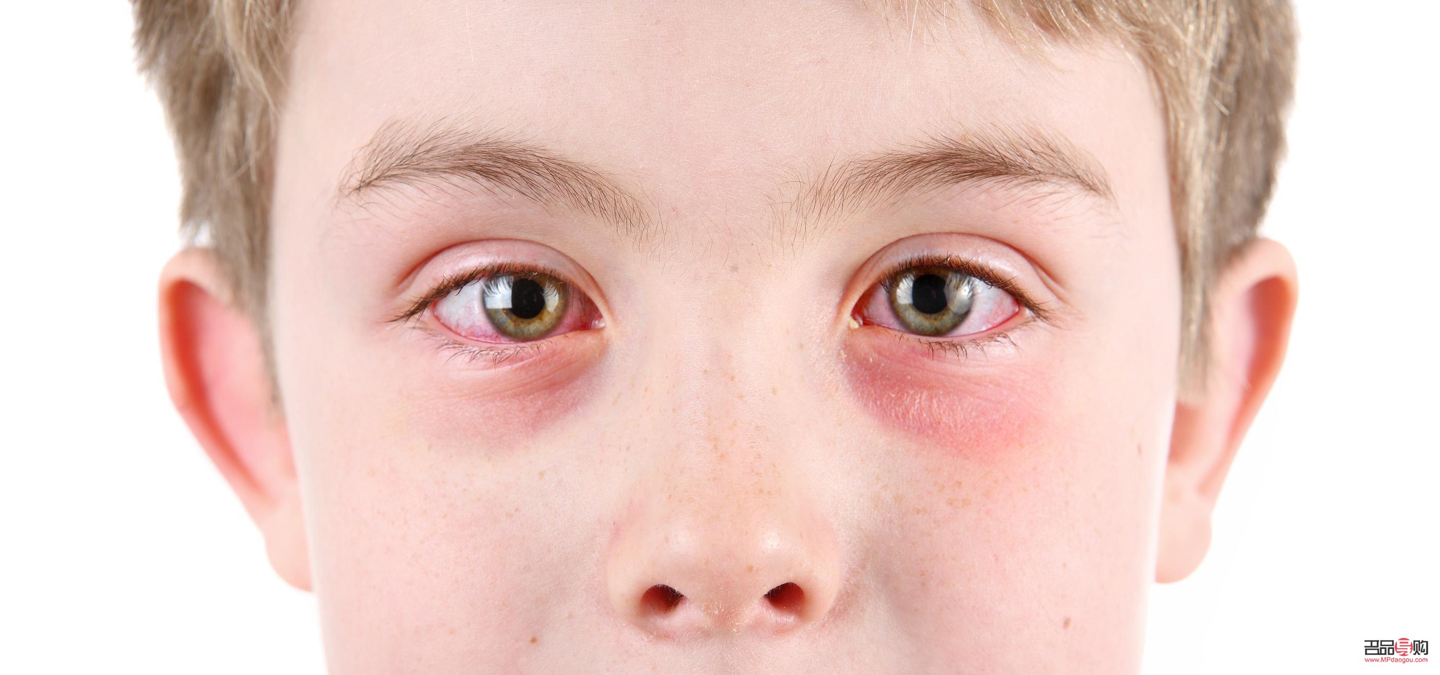 早上起床眼睛浮腫怎么回事(最近早上起床眼睛浮腫怎么回事)