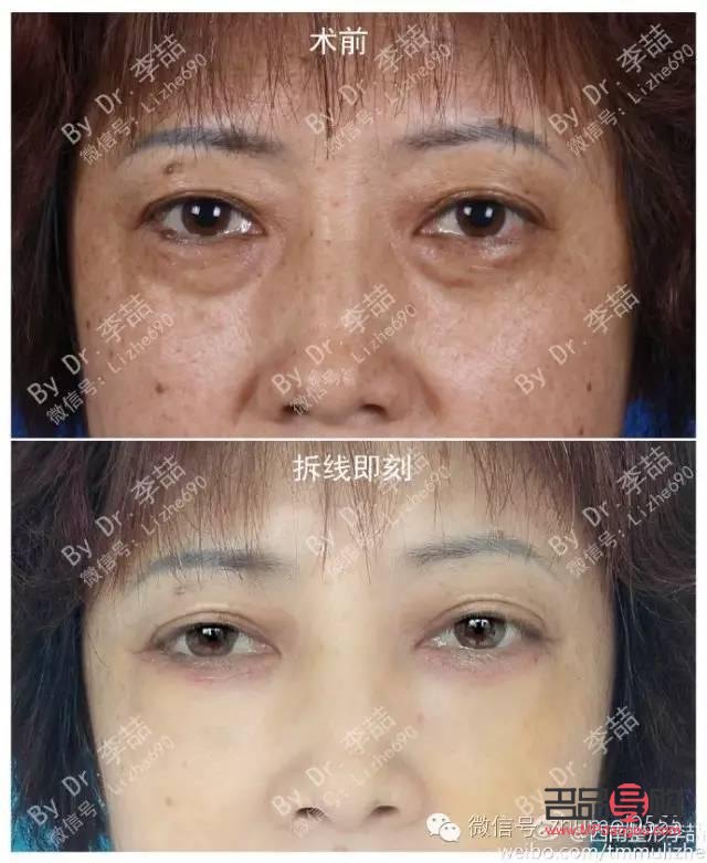 去眼袋眶隔釋放安全嗎(眶隔釋放淚溝填充能保持幾年)