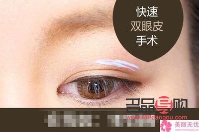無痕雙眼皮是什么意思圖片(無痕雙眼皮是什么意思圖片女)