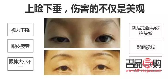 如何提升上眼皮肌肉(如何提升上眼皮肌肉層次)