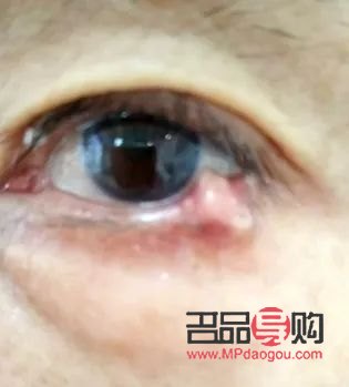 <h3>探索下眼瞼紋去除之道，重拾眼部青春魅力</h3>