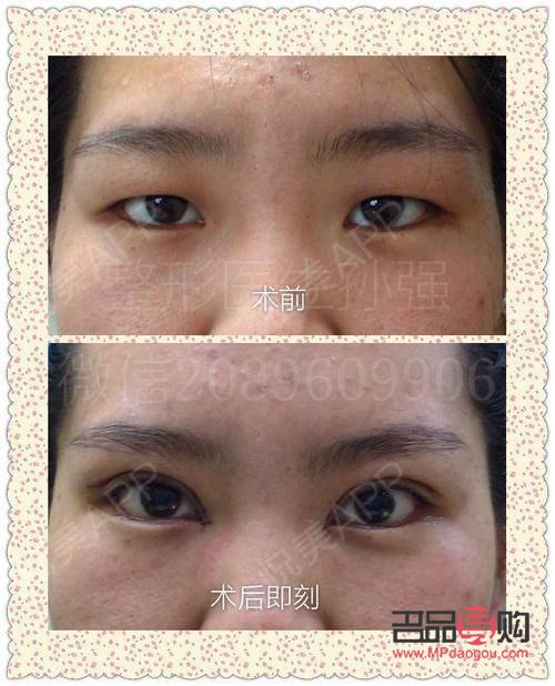 腫眼泡割雙眼皮自然嗎(腫眼泡可以只抽脂不割雙眼皮嗎)