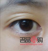 三眼皮(三眼皮怎么恢復(fù)雙眼皮)