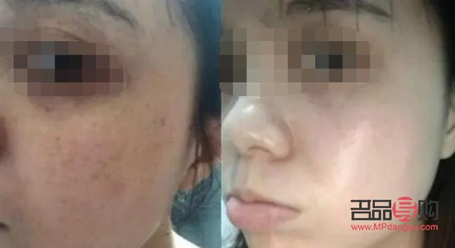 哪里美容去斑好(哪里美容去斑好)