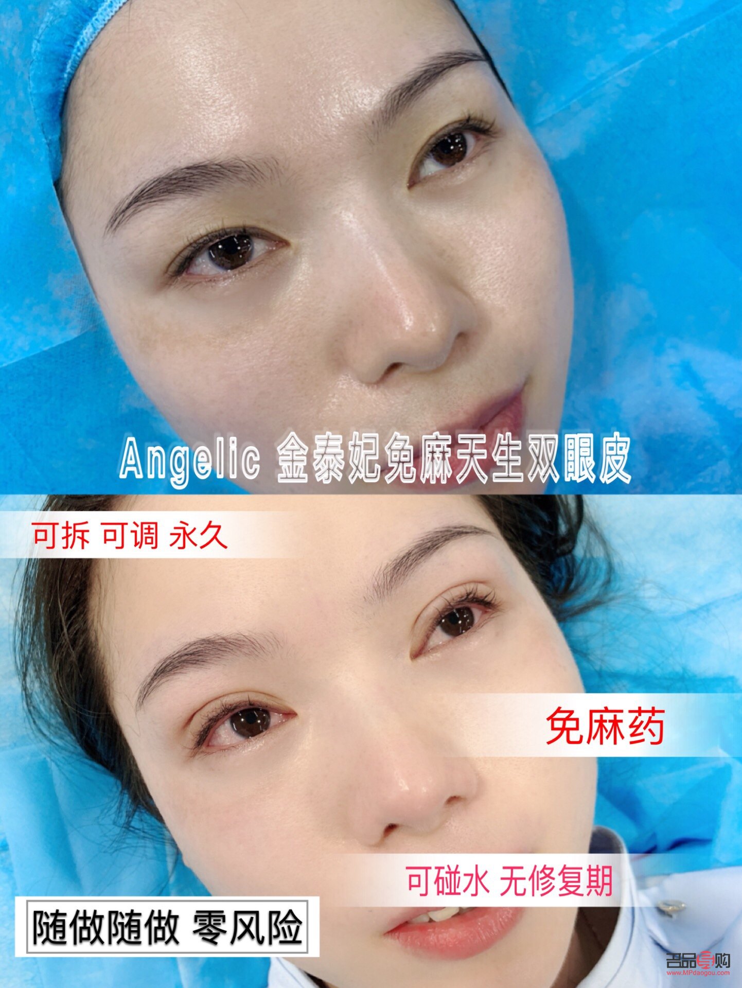 免麻無痕雙眼皮手術風險解析