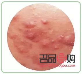 身體火燒怎么護(hù)理(身體火燒怎么護(hù)理最好)