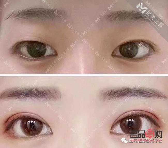 雙眼皮類型有哪些圖片大全(雙眼皮類型有哪些圖片大全圖解)