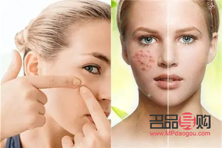 美容院怎么去粉刺(美容院怎么去粉刺的)