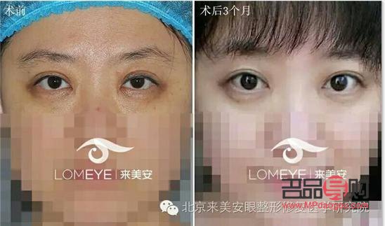 雙眼皮一邊寬一邊窄怎么修復(fù)好(雙眼皮一邊寬一邊窄怎么修復(fù)好呢)