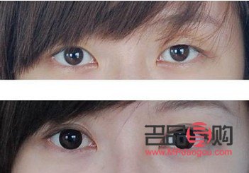 <h3>雙眼皮翹睫手術(shù)：綻放雙眼魅力，實現(xiàn)自然美眸</h3>