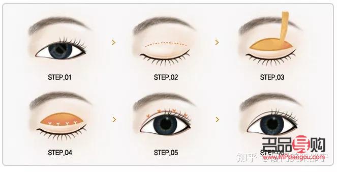 <h3>單眼皮變雙眼皮秘籍：非手術(shù)方法大揭秘</h3>