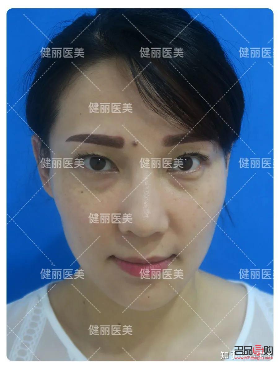 <h3>眼袋能徹底去除嗎？</h3>