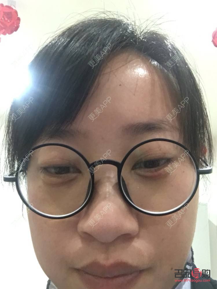 <h3>眼袋能徹底去除嗎？</h3>