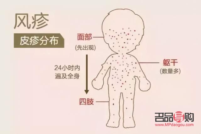 風(fēng)疹應(yīng)該如何護(hù)理身體(風(fēng)疹應(yīng)該如何護(hù)理身體健康)