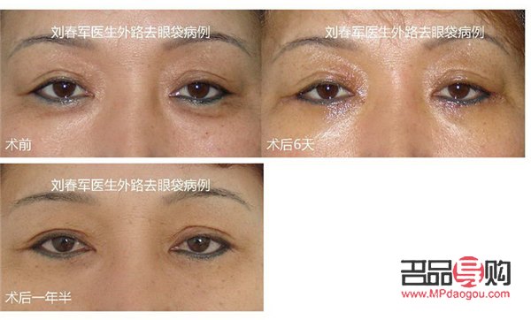 眼袋手術(shù)后的增生一般都能消失嗎(眼袋手術(shù)后的增生一般都能消失嗎圖片)