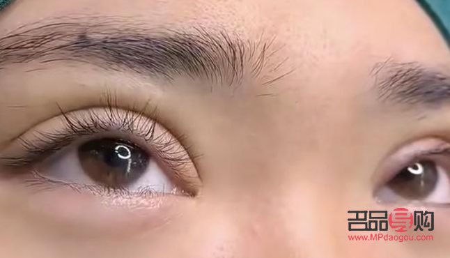 雙眼皮翹睫術(shù)前后圖片(翹睫術(shù)是怎么做的)