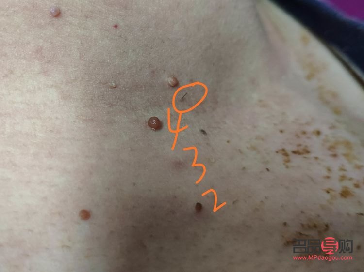 <h3>長疣怎么身體護(hù)理</h3>