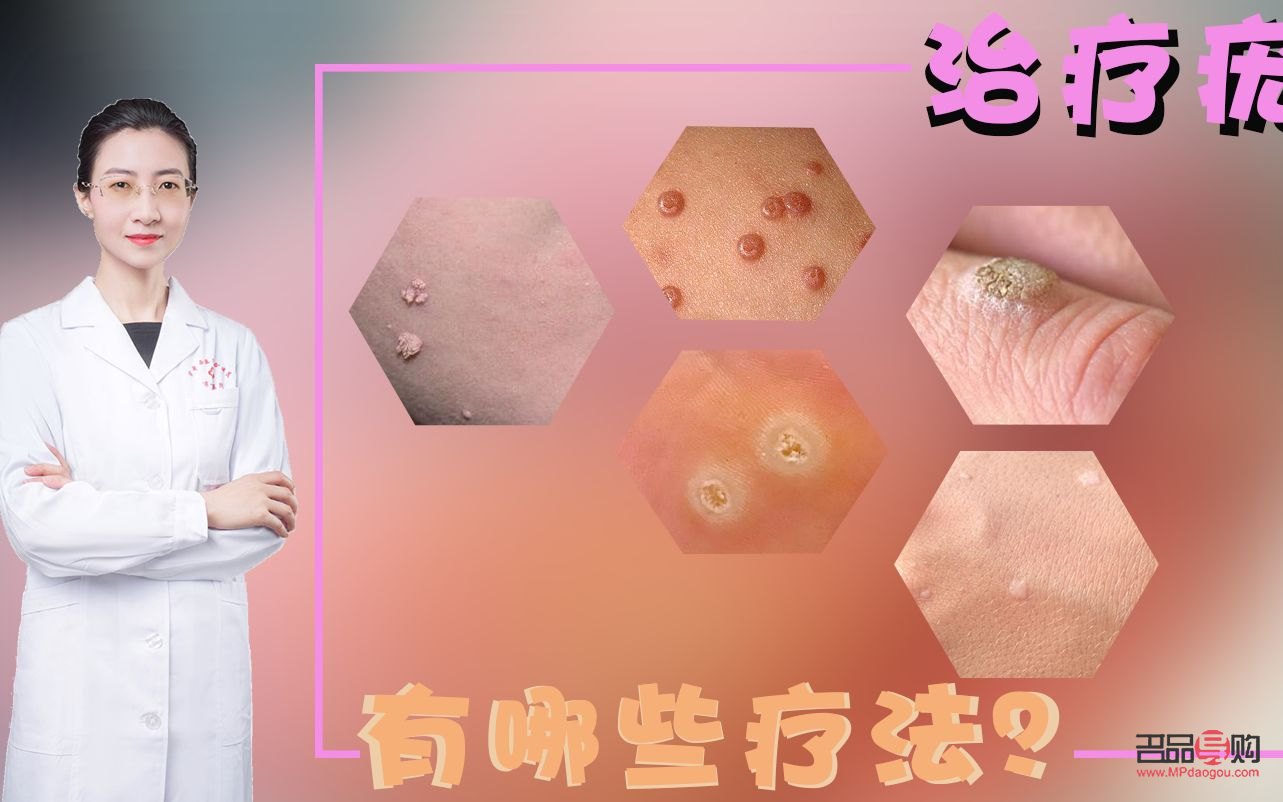 長(zhǎng)疣怎么身體護(hù)理