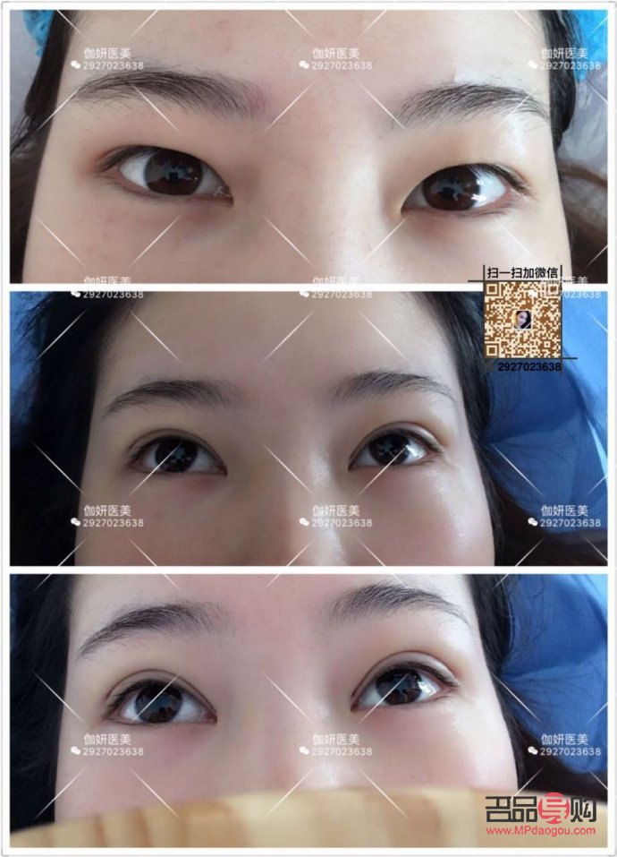 韓國納米無痕雙眼皮是什么技術(韓國納米無痕雙眼皮介紹)