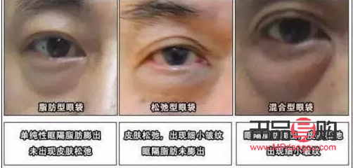 臥蠶與眼袋：你真的能分清嗎？