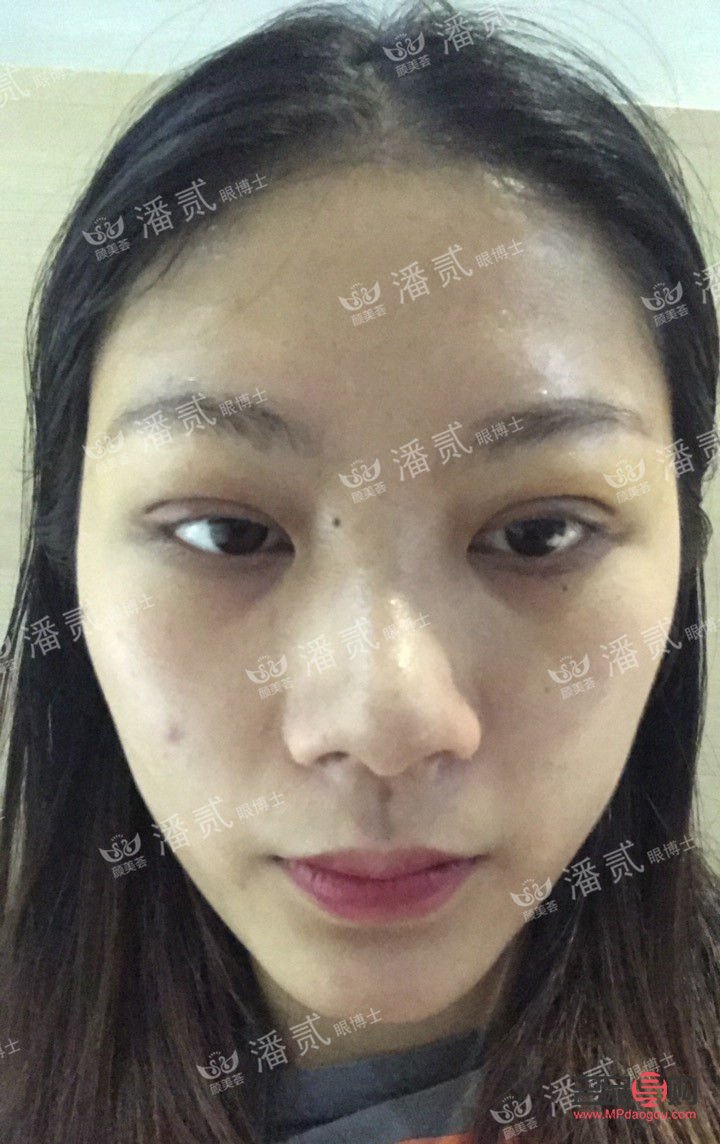 告別腫眼泡的秘訣與偏方