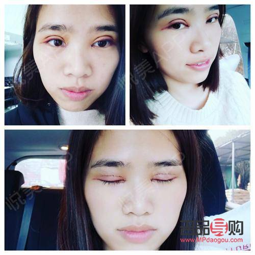 割雙眼皮后多久恢復(fù)自然(割雙眼皮后多久恢復(fù)自然一點)