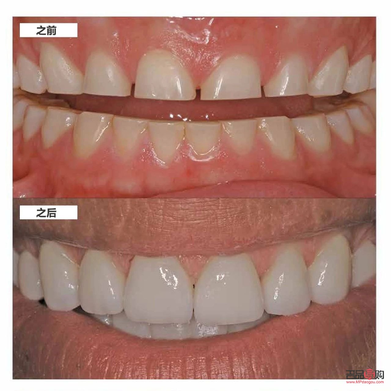 <h3>美容冠：美麗與健康的雙重保障</h3>