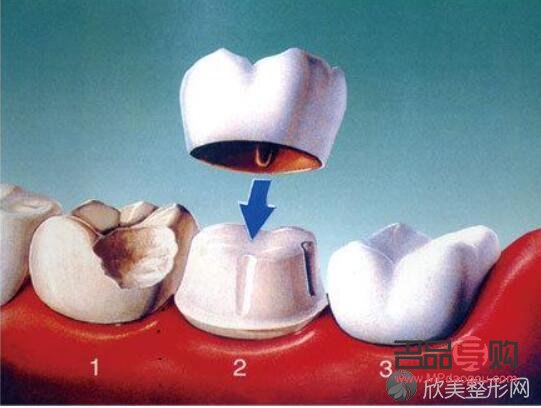 <h3>美容冠：美麗與健康的雙重保障</h3>