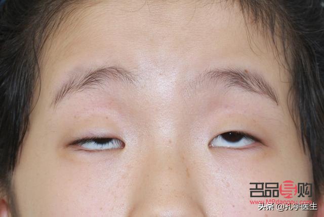 睜眼需要抬眉毛(睜眼需要抬眉毛一定得提肌嗎)