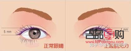 睜眼需要抬眉毛(睜眼需要抬眉毛一定得提肌嗎)