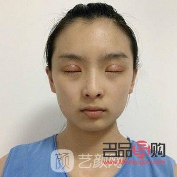 眼綜合20天依然腫脹，如何應對？