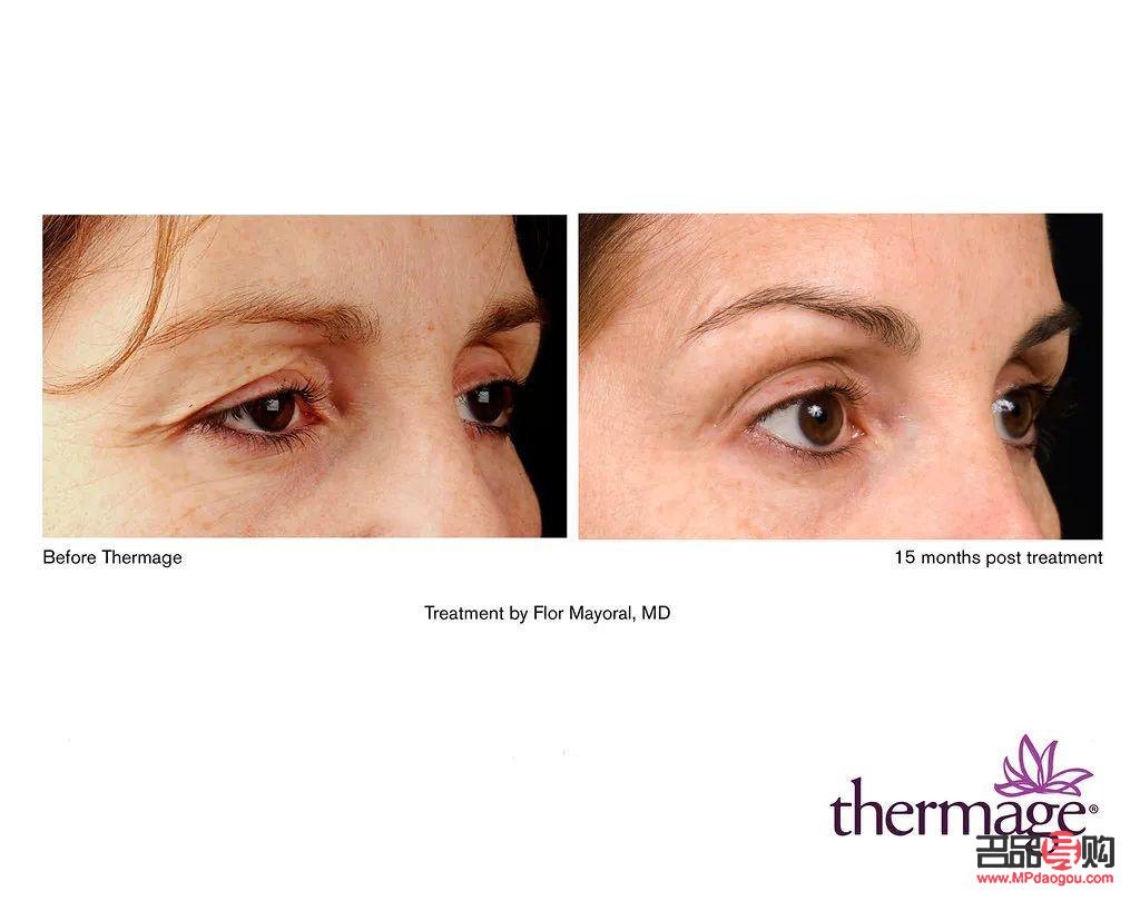 <h3>眼部衰老如何選擇合適的眼霜</h3>