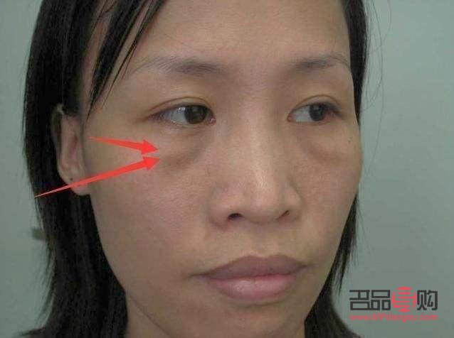 提拉眼角是不是辱華(提拉眼角多少錢)