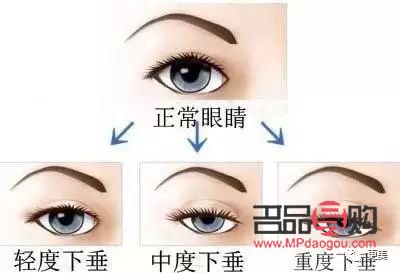 14歲內(nèi)雙眼皮還能不能變雙眼皮(14歲雙眼皮就定型了嗎)