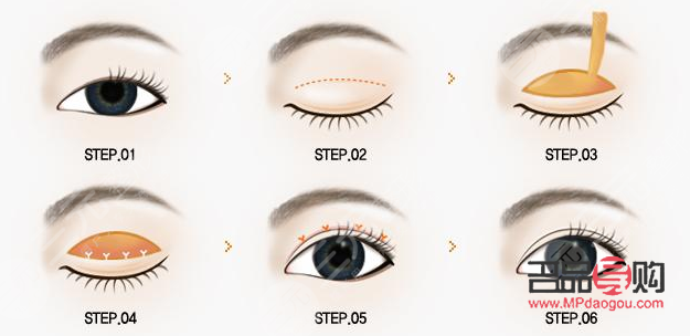 做雙眼皮手術(shù)多少錢(西南醫(yī)院做雙眼皮手術(shù)多少錢)