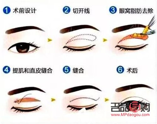 做雙眼皮手術(shù)多少錢(西南醫(yī)院做雙眼皮手術(shù)多少錢)