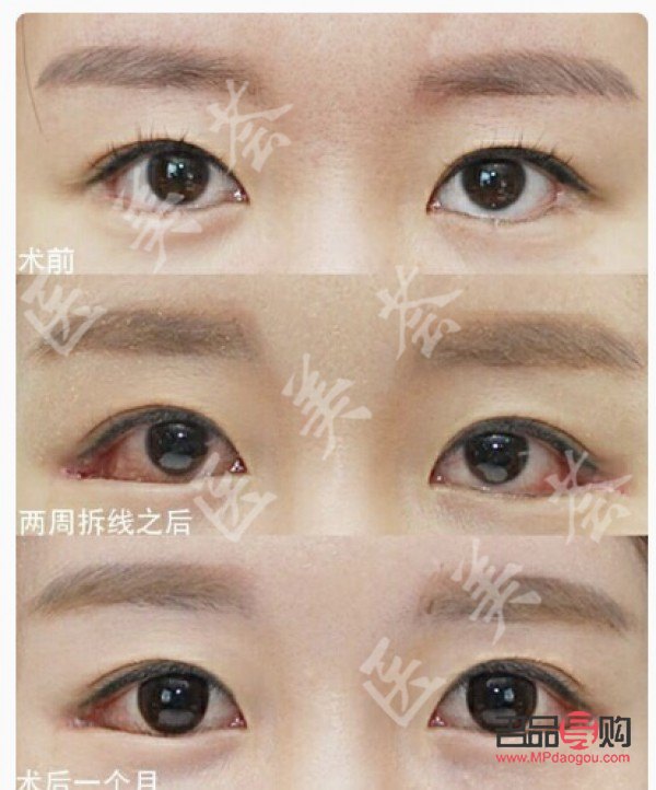 眼瞼下至手術前后圖片(眼瞼下垂手術風險大嗎)