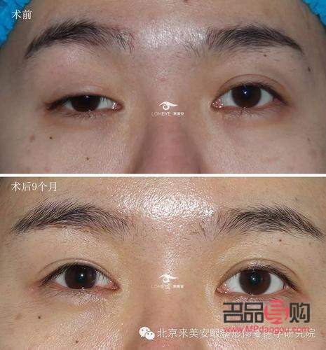 眼瞼下至手術前后圖片(眼瞼下垂手術風險大嗎)