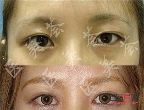 眼瞼下至手術前后圖片(眼瞼下垂手術風險大嗎)