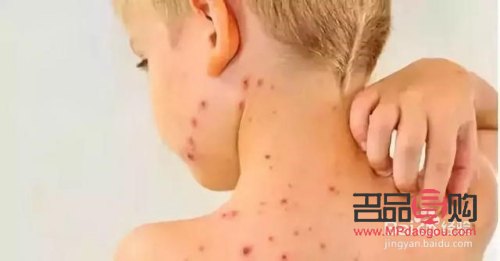 生水痘后如何護理身體(生水痘后如何護理身體好)