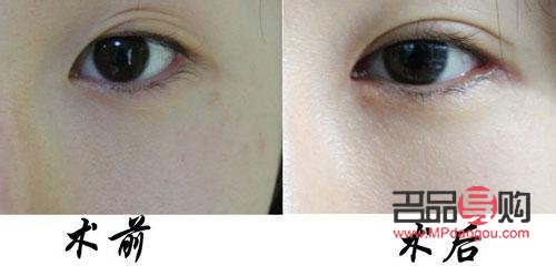 雙眼皮失敗的八種圖片你屬于那種(雙眼皮失敗的八種圖片 新聞)