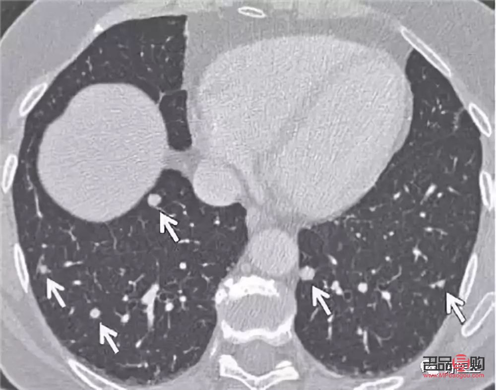 <h3>肺結(jié)節(jié)后的身體護(hù)理指南</h3>
