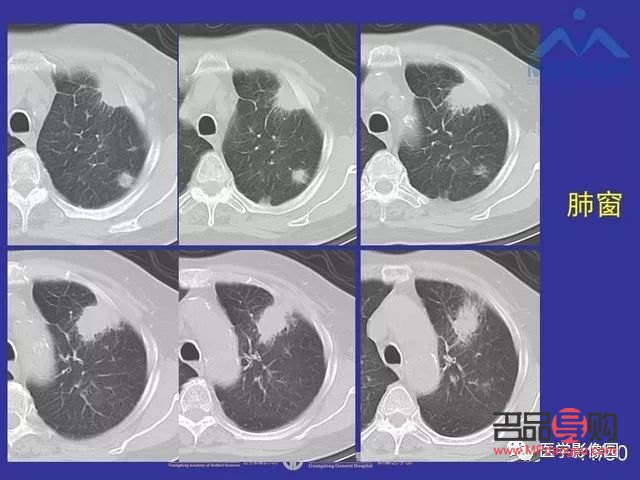 <h3>肺結(jié)節(jié)后的身體護(hù)理指南</h3>