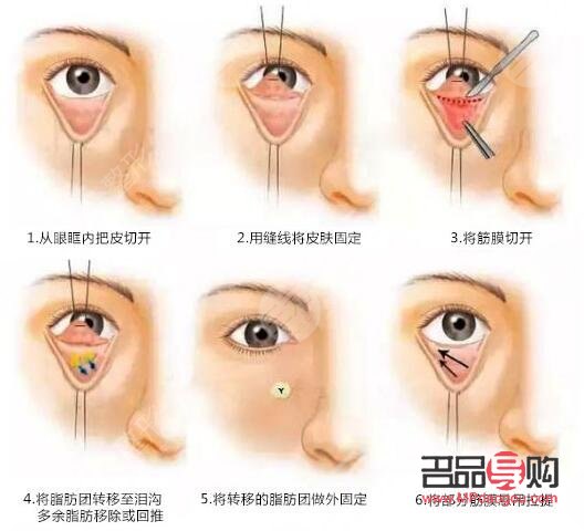 切眼袋后注意事項(去眼袋手術(shù)警惕三大后遺癥)