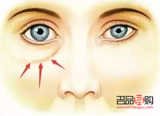 切眼袋后注意事項(去眼袋手術(shù)警惕三大后遺癥)